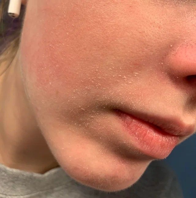 over-treated skin