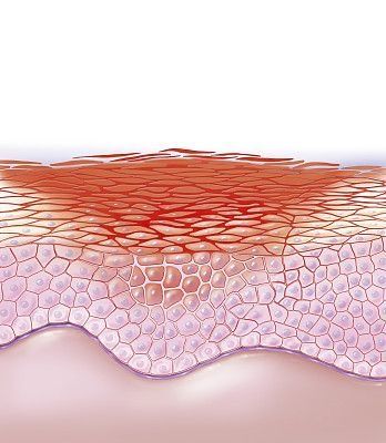 Skin Barrier