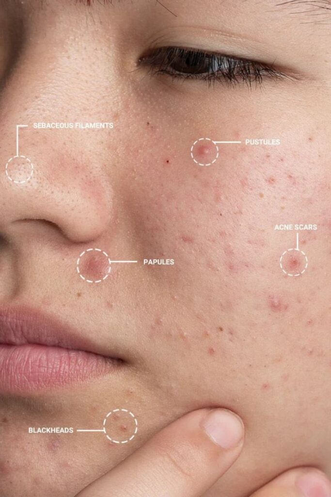 stress and skin