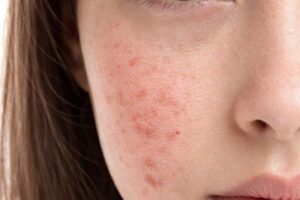 stress and skin2