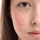 How Stress Affects Your Skin and What You Can Do to Fix It