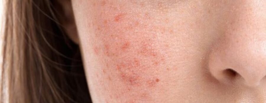 stress and skin2