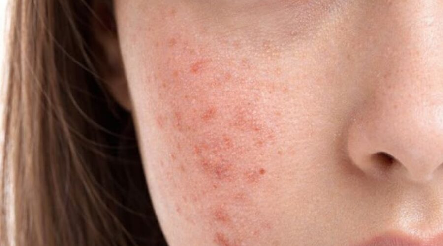 stress and skin2